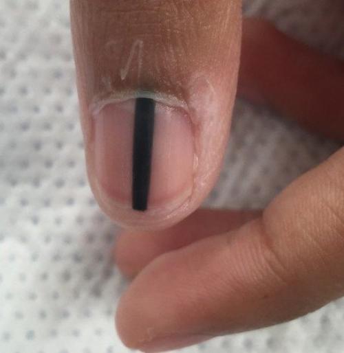 Доброкачественные опухоли ногтя и возле ногтя. Виды и симптомы 02