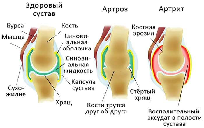 Почему болят суставы при смене погоды? изменения, суставы, хрящевой, погоды, начинают, суставов, ткань, подобные, состояния, давление, погоде, суставах, воспаленные, может, сустав, различных, заболеваний, хрящевая, нервных, ткани