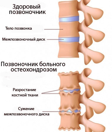 Здоровый позвоночник и межпозвоночные диски и позвоночник больного остеохондрозом на схематичном рисунке