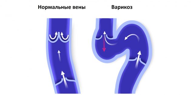 Кто такой флеболог и при каких симптомах надо к нему идти которые, сердцу, кровь, венах, этого, крови, могут, расширение, венам, флеболог, может, чулки, организма, целом, венозной, ногах, сосудов, тромбов, воспаление, клапаны