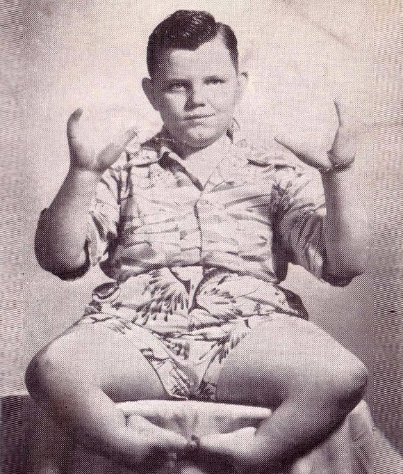 5. Еще один известный фрик 20 века - "Лобстер-мальчик" интересно, история, люди-мутанты, мутации, прошлое, фото