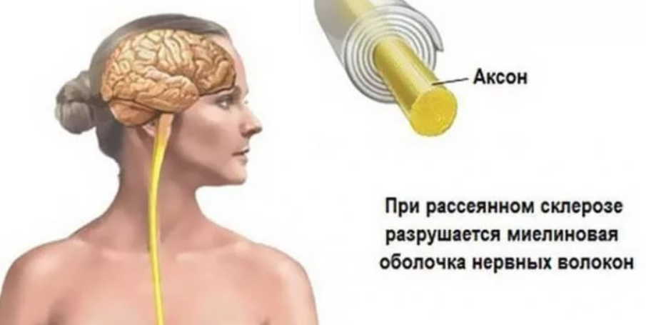 Народные средства для улучшения мозгового кровообращения: скажи "нет" слабоумию, рассеянности и немощи!