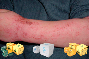 Применение крем-воска «ЗДОРОВ» от дерматита