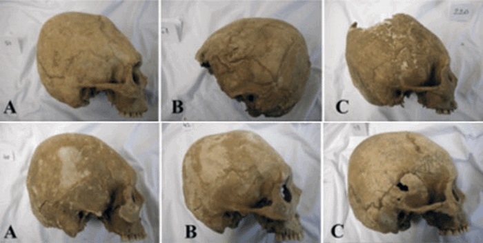 Красота требует жертв: 10 исторических примеров деформации черепов древними людьми