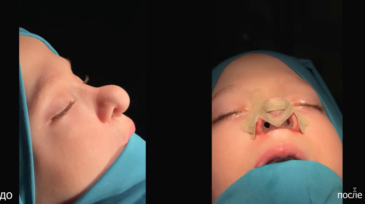 Как сейчас выглядит девочка Варя из Калужской области, которой в 10 лет прооперировали нос девочки, детей, после, делать, блогер, операции, только, Сергей, результат, когда, родилась, Лукьянов, девочка, занимается, операцию, быстро, длительного, очень, стало, мамой