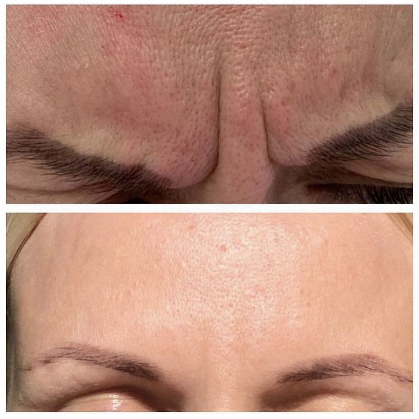 Косметолог показала, как инъекции ботокса меняют лицо: фото до и после косметология,красота