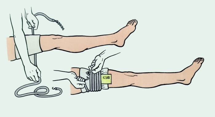 Массивная кровопотеря и способы борьбы с ней: жгут и турникет армия,оружие