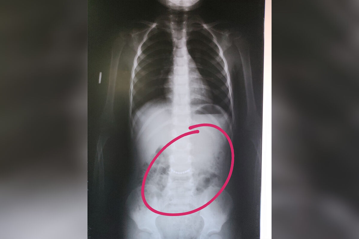 В Башкирии в брюшной полости трехлетнего мальчика нашли металлическую цепочку