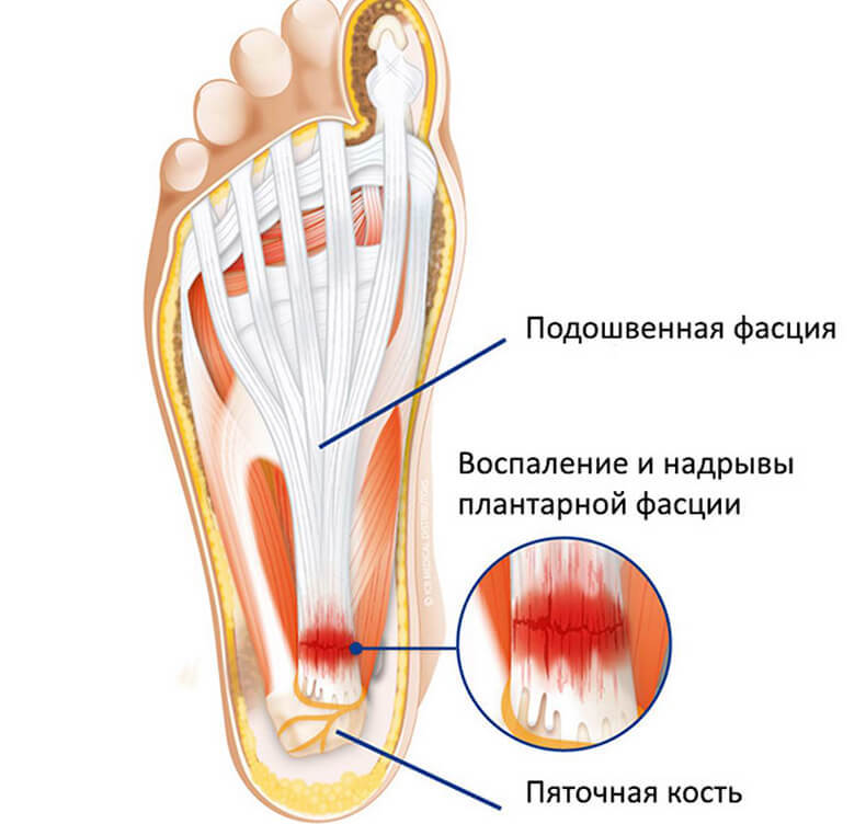 Боль в пятке: 9 возможных причин