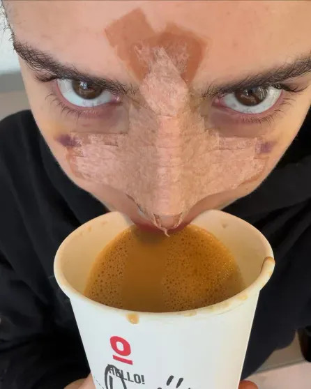 Дина Саева показала себя после операции на носу Саева, СаеваДина, также, Саевой, дышать, сделала, блогерша, конце, операцию, слухи, подтвердили, нормально, после, операцииДина, экстремистской, Никитой, появились, СаеваЛетом, грудиДина, увеличению