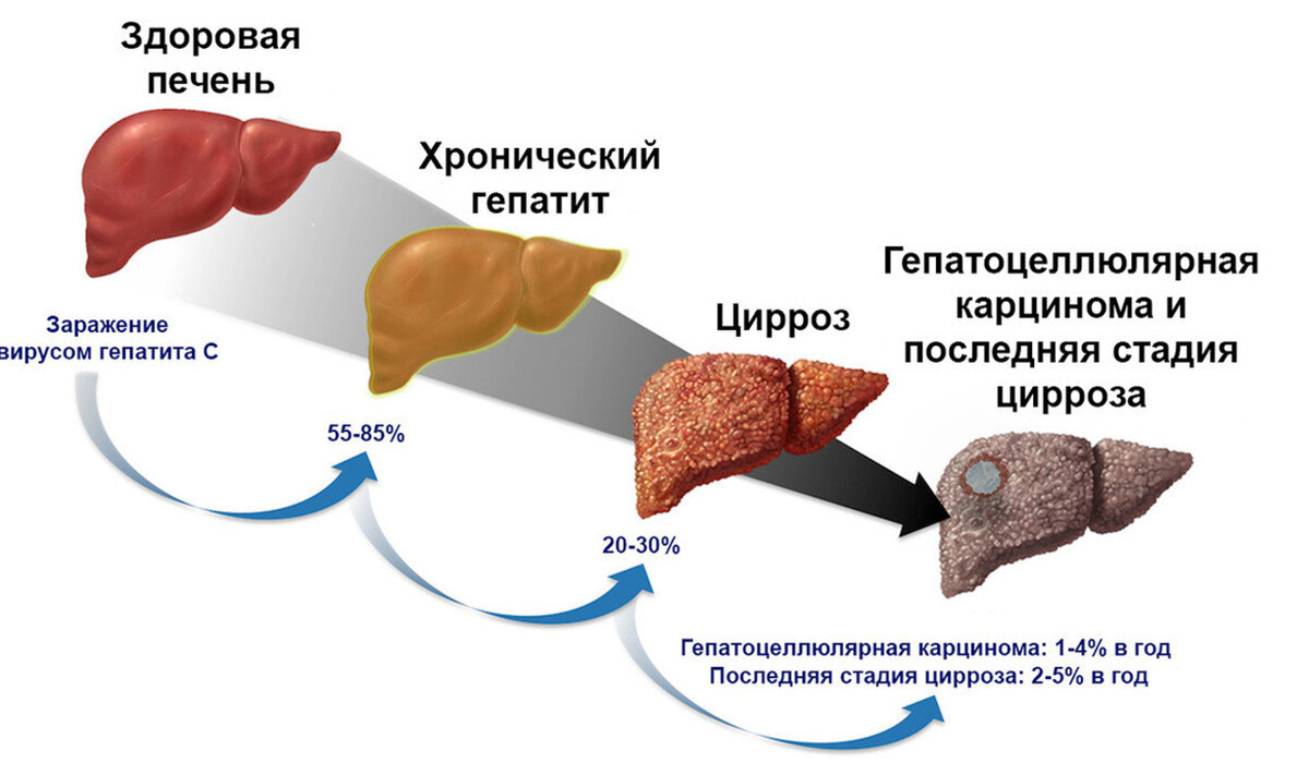 Цирроз печени: все что надо знать