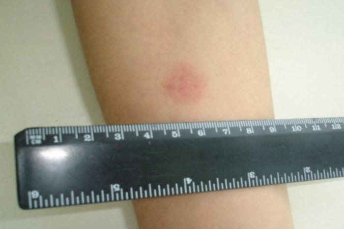  Чтобы вода в самом деле повлияла на реакцию Манту, ее нужно вводить внутрикожно / Фото: ganiko.ru