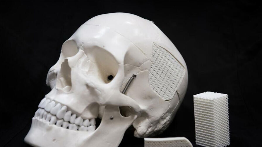 Российские ученые усовершенствовали материал для имплантов черепа