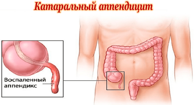 Катаральный аппендицит